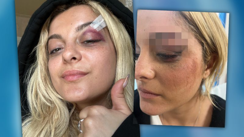Bebe Rexha hit in the face with phone during concert